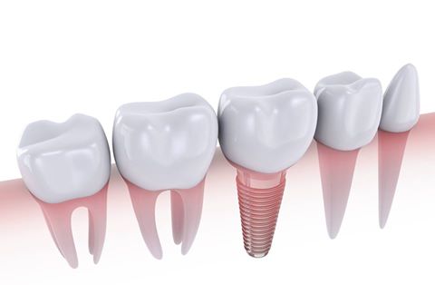 Dental Implant